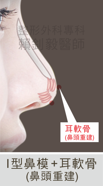 I型鼻模和耳軟骨重建鼻頭示意圖