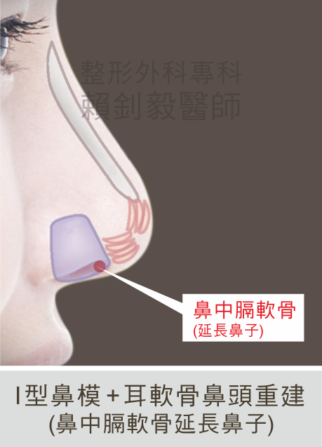 I型鼻模、耳軟骨重建鼻頭和鼻中膈軟骨延長鼻小柱和鼻頭示意圖